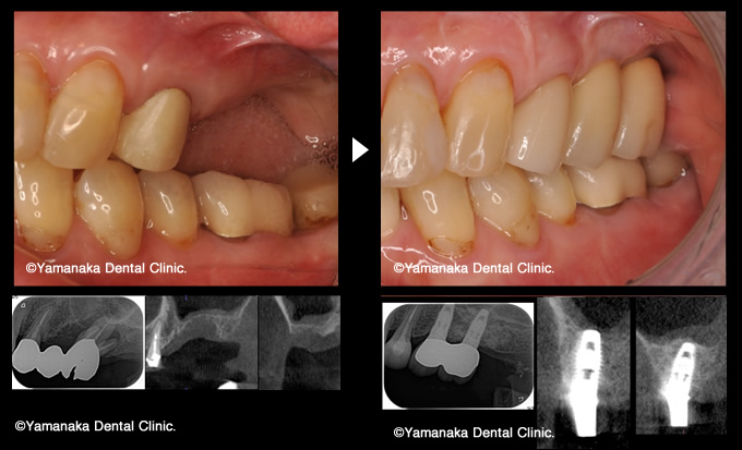 重度歯周病のインプラント