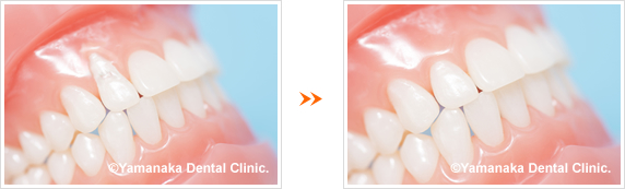 歯茎再生のイメージ