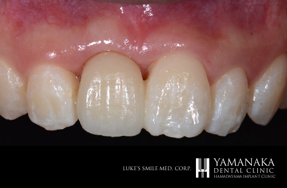 接着性ブリッジをセット