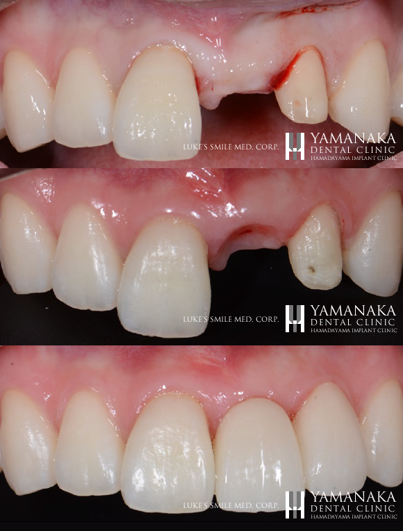 接着性ブリッジ症例