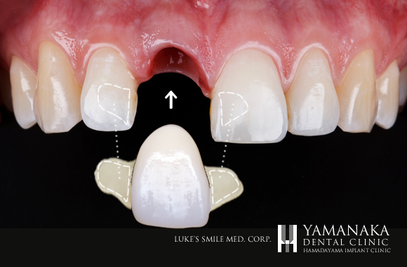 接着性ブリッジ