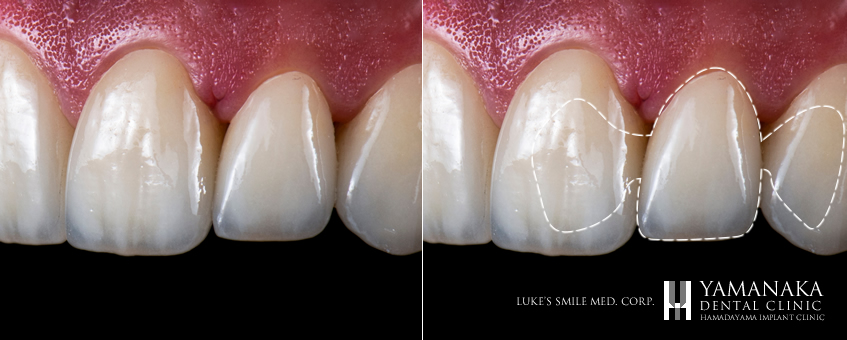 接着性ブリッジ